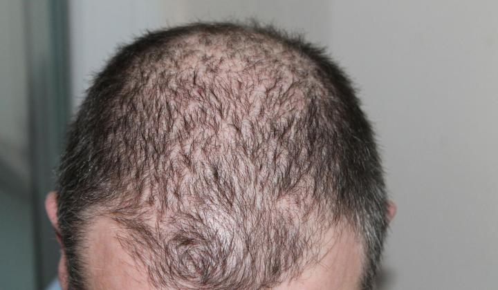 Jak léčit plešatost – 5 metod, jak se vypořádat s vypadáváním vlasů Jak léčit plešatost – 5 metod, jak se vypořádat s vypadáváním vlasů
